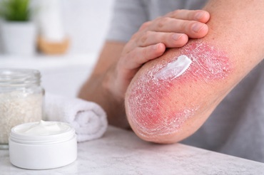 Pikkelysömör kezelése házilag – mit tehetünk a tünetek enyhítésére?